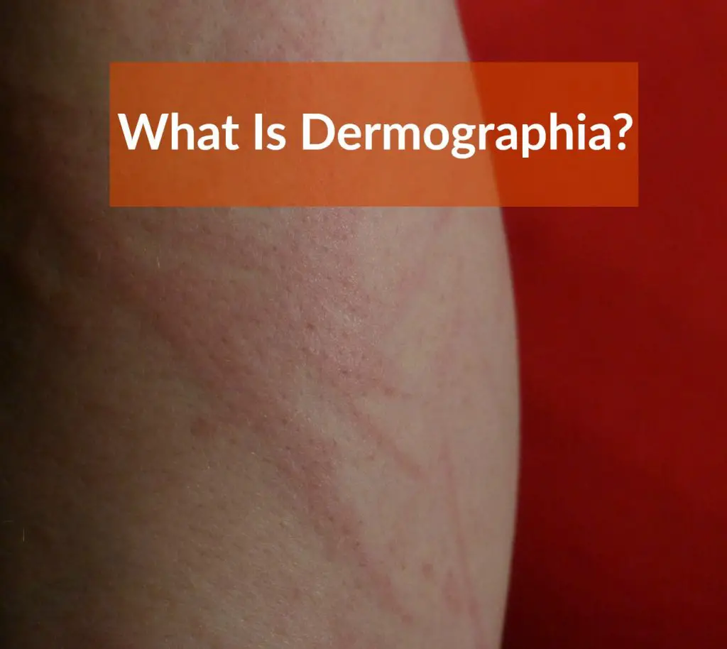 Dermographia Dermographism Causes Symptoms Treatment