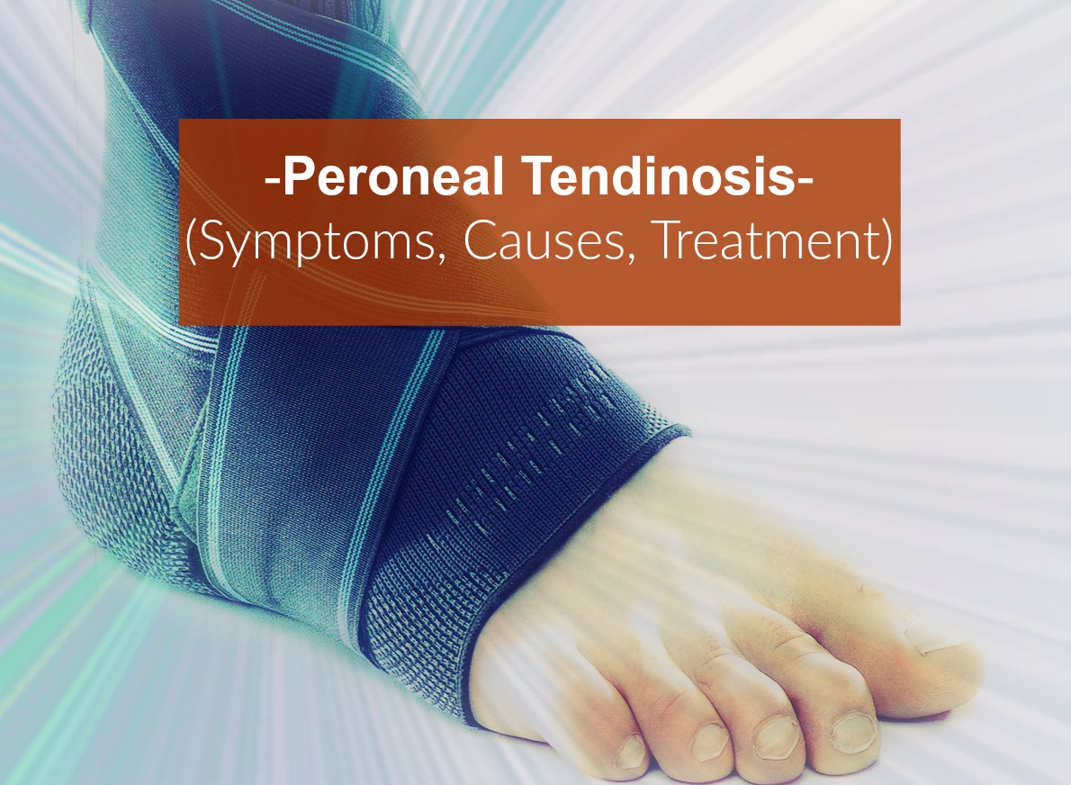 Peroneal Tendonitis Causes Symptoms Diagnosis Treatment And Recovery 