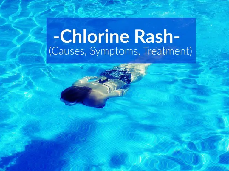 Chlorine Rash (Causes, Symptoms, Treatment) The Healthy Apron