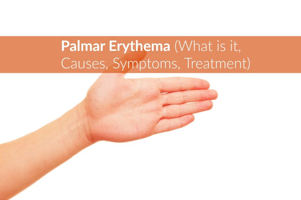 palmar-erythema-what-is-it-causes-symptoms-treatment-the-healthy